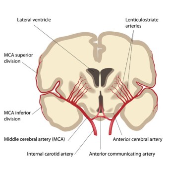 Cerebral Embolectomy by OrangeCountySurgeons